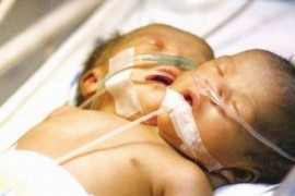 O chinezoaica a nascut o fetita cu doua capete