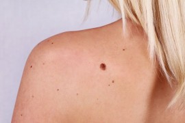 4 factori de risc mai putin cunoscuti pentru cancerul de piele!